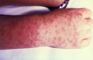 Rocky Mountain spotted fever symptoms